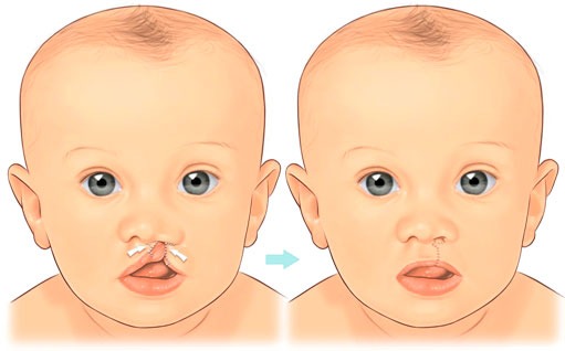 Cirurgia Lábio Leporino. Imagem: Google.